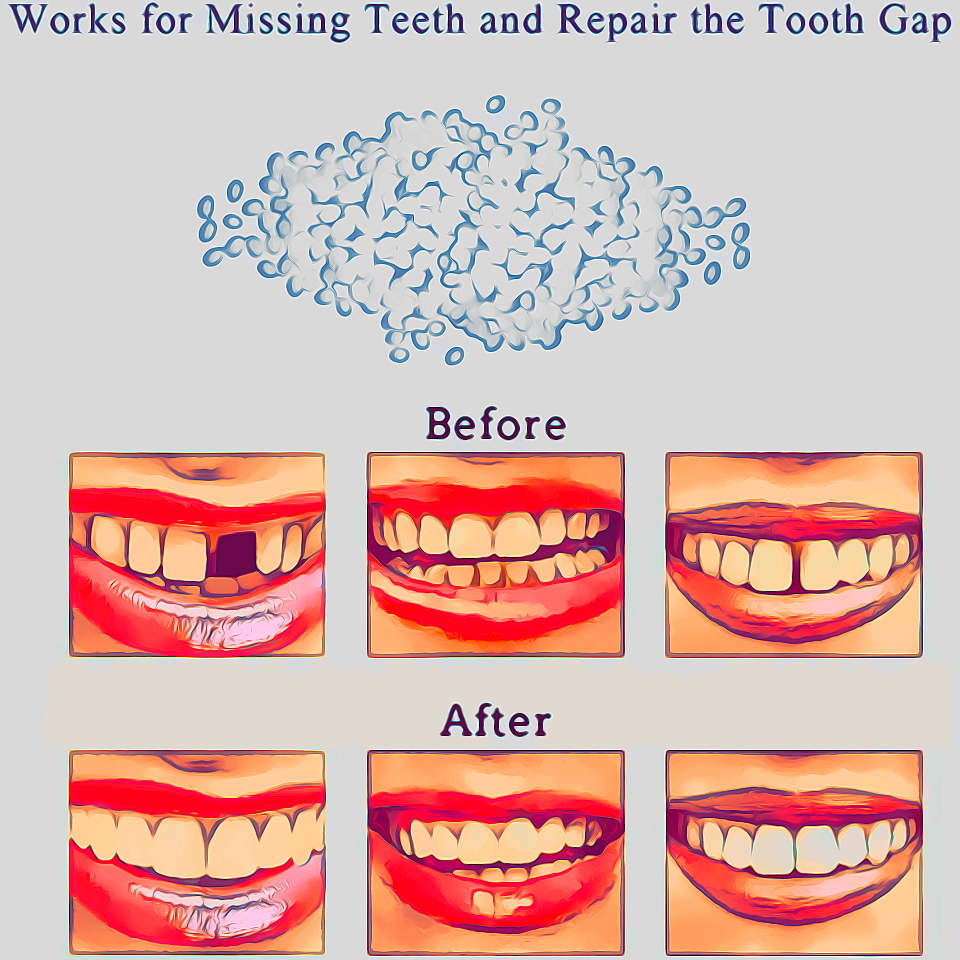 Best Temporary Filling for Tooth